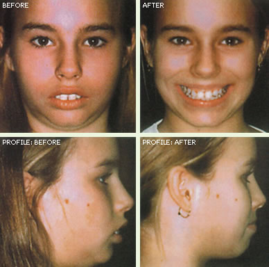 Braces - ages 12 to 14 • Teeth are straightened with braces