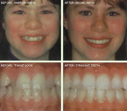 before and after orthodontic pictures